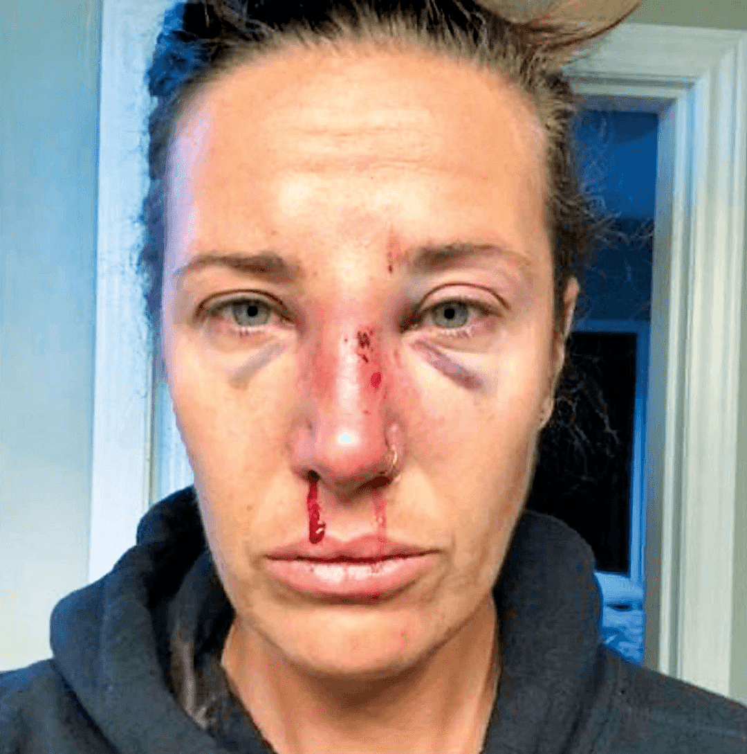 RCMP再次被曝暴力执法！加拿大女子报警求救，却被打断鼻梁，还被打掉两颗牙齿！（组图） - 10