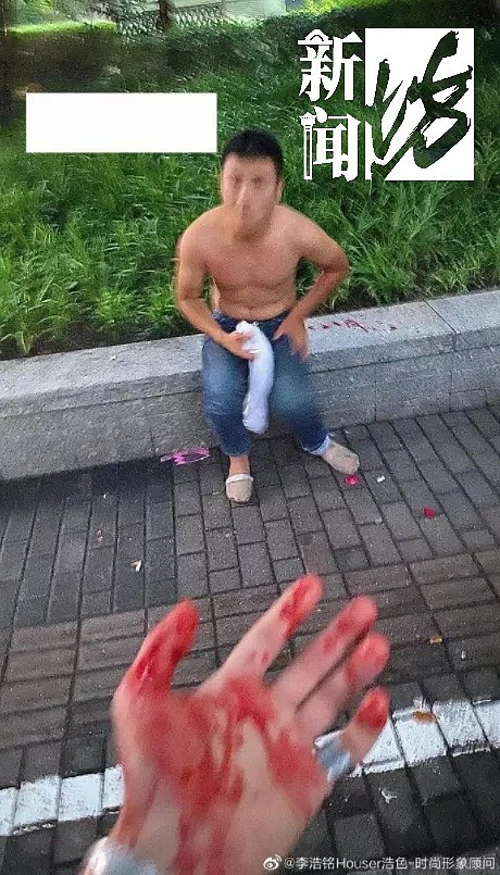 光天化日，竟有人当街非礼女性！上海一小伙见义勇为，被咬掉近半个耳朵…（组图） - 2