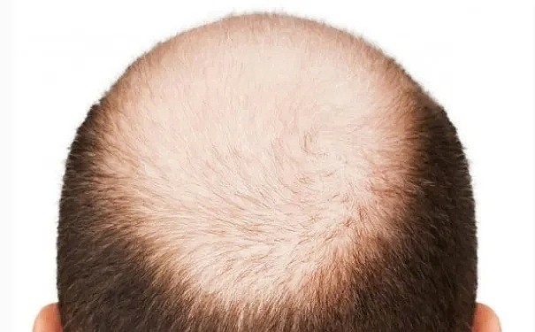 悲剧！秃头男性感染新冠肺炎风险高达40%，一医院男性患者几乎都是秃顶（组图） - 3