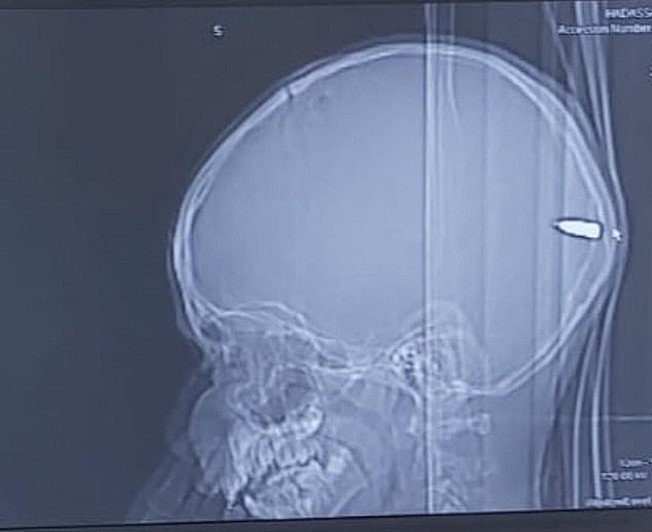 以色列一名9岁巴勒斯坦男孩日前因昏昏欲睡就医，检查后发现他的大脑卡着一颗子弹，值班的神经外科医师立刻决定开刀取出。 (翻摄：MAILONLINE)
