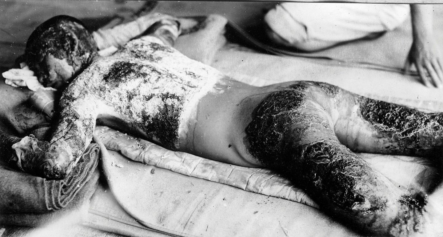 1945年8月6日，美国在日本广岛投掷原子弹后，在陆军运输检疫站的一名男子身体烧伤。（Reuters）
