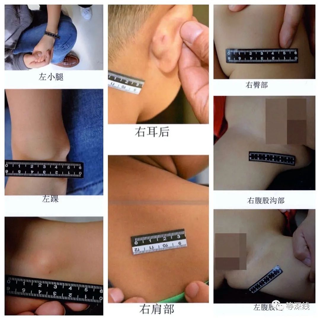 天津37名儿童被针扎虐待：老师用大头针图钉扎，还说“挺管用（组图） - 1