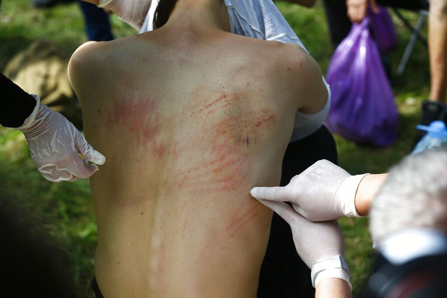 2020年8月14日，白罗斯一名示威者在离开拘留中心后展示自己的伤势（AP）