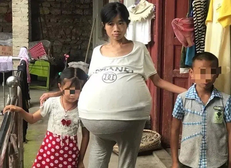 恐怖！2年时间中国妈妈肚子疯长成巨球，每晚只能坐着睡觉…全靠10岁儿子支援家庭（组图） - 2