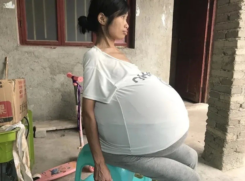 恐怖！2年时间中国妈妈肚子疯长成巨球，每晚只能坐着睡觉…全靠10岁儿子支援家庭（组图） - 3