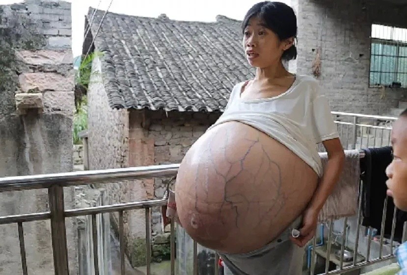 恐怖！2年时间中国妈妈肚子疯长成巨球，每晚只能坐着睡觉…全靠10岁儿子支援家庭（组图） - 5