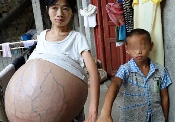 恐怖！2年时间中国妈妈肚子疯长成巨球，每晚只能坐着睡觉…全靠10岁儿子支援家庭（组图） - 9