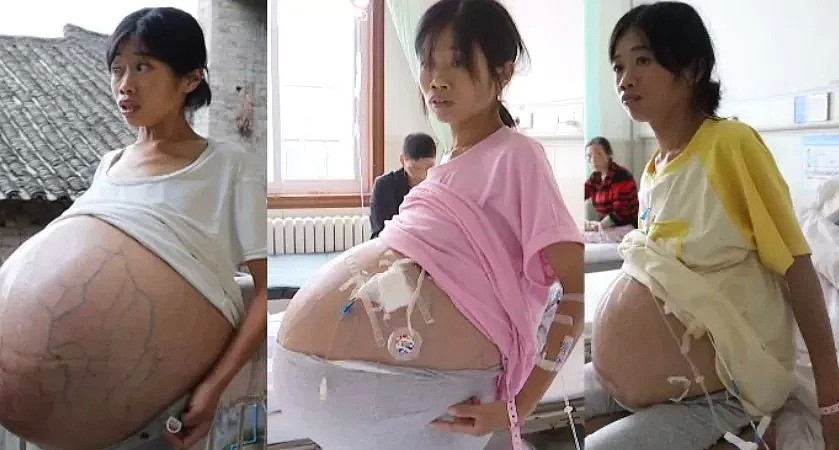 恐怖！2年时间中国妈妈肚子疯长成巨球，每晚只能坐着睡觉…全靠10岁儿子支援家庭（组图） - 11