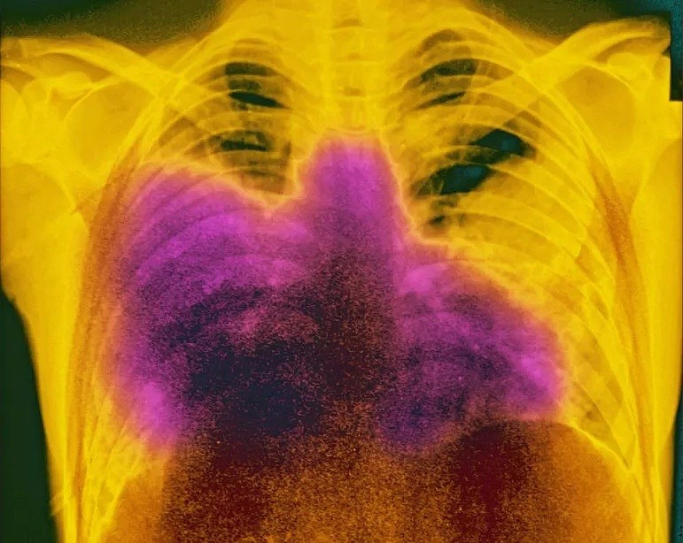 警报！新非典型肺炎爆发，死亡率是新冠15倍，已多人确诊，感染源不明（组图） - 14