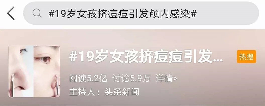 中国19岁女孩颅内感染，冲上热搜第一，黄晓明也差点深陷其中！3万多名网友吓懵（视频/组图） - 2