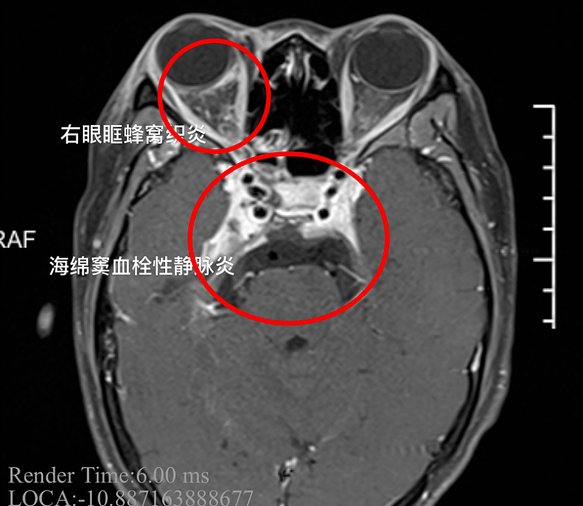 中国19岁女孩颅内感染，冲上热搜第一，黄晓明也差点深陷其中！3万多名网友吓懵（视频/组图） - 5