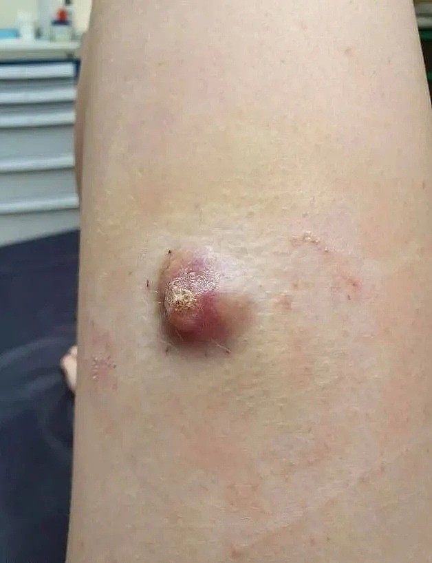 澳洲女子腿上长包，医生说没事，一年后被确诊癌症晚期！然而这个病很常见（组图） - 4