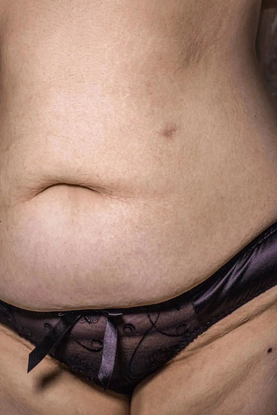 【女性】大码女孩只想活命：为了减肥，我把胃切除了（组图） - 6
