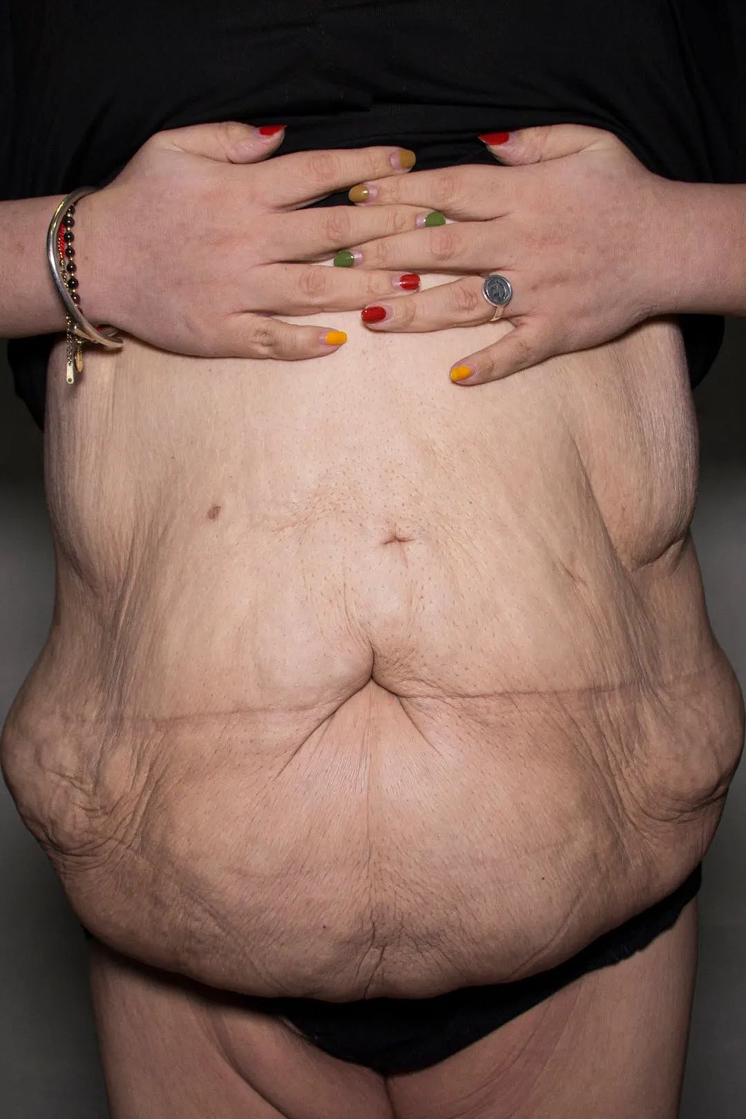 【女性】大码女孩只想活命：为了减肥，我把胃切除了（组图） - 18