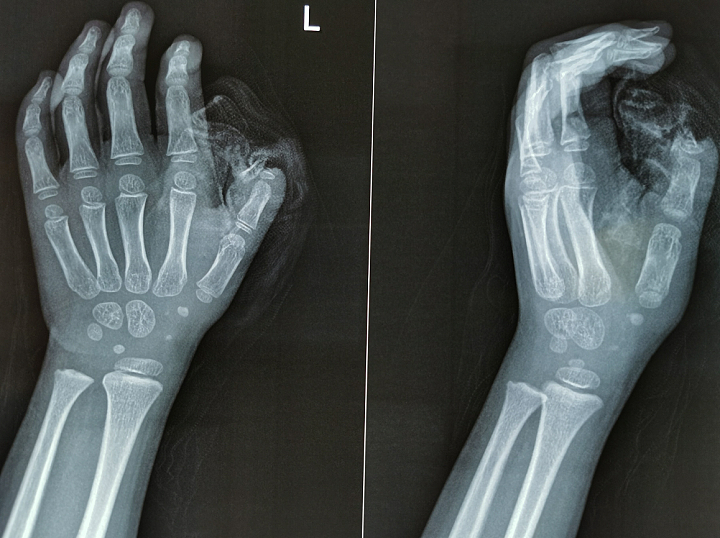 惊呆！中国5岁女孩大拇指被防盗门生生夹断，医生把断指“种”到她肚皮上（图） - 1