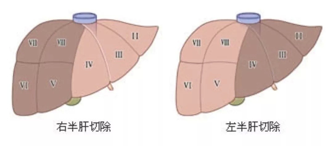 男子左肝被掏空，布满密密麻麻的虫卵，只因吃了这个…澳洲随处可见，很多华人都爱吃！ - 11