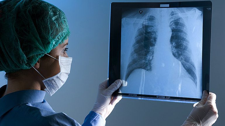 physcian holding xray lungs 770 433.jpg,0