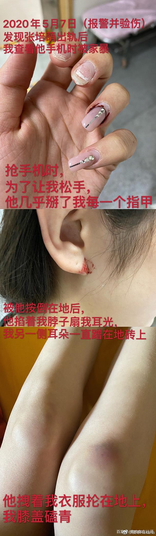 美女主播自爆运动员丈夫孕期家暴，被拔指甲还抢孩子，男方却甩锅给激素太无语（组图） - 14