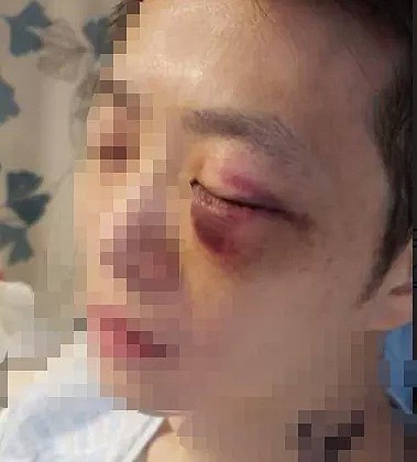 新西兰多名华人无端遇袭被打，致鼻青脸肿、面部缝针！种族歧视卷土重来？（组图） - 6