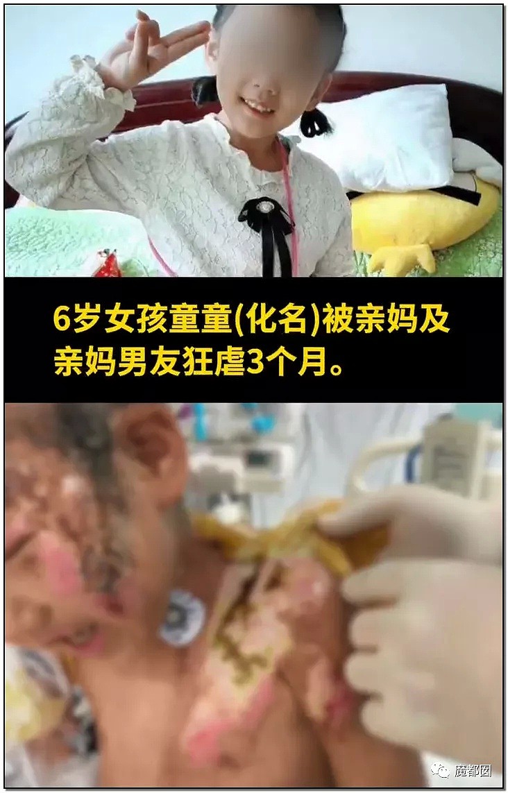 内幕扒出！沸水浇、钳拔牙、掰碎手、烧嘴唇…中国6岁女童被亲妈虐惨（视频/组图） - 3