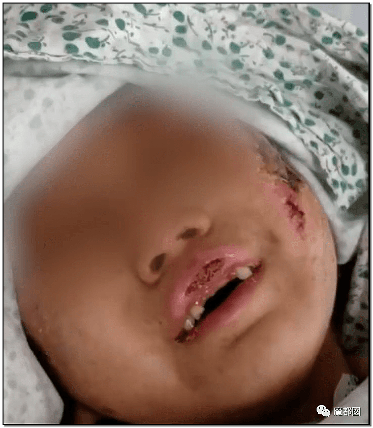内幕扒出！沸水浇、钳拔牙、掰碎手、烧嘴唇…中国6岁女童被亲妈虐惨（视频/组图） - 17