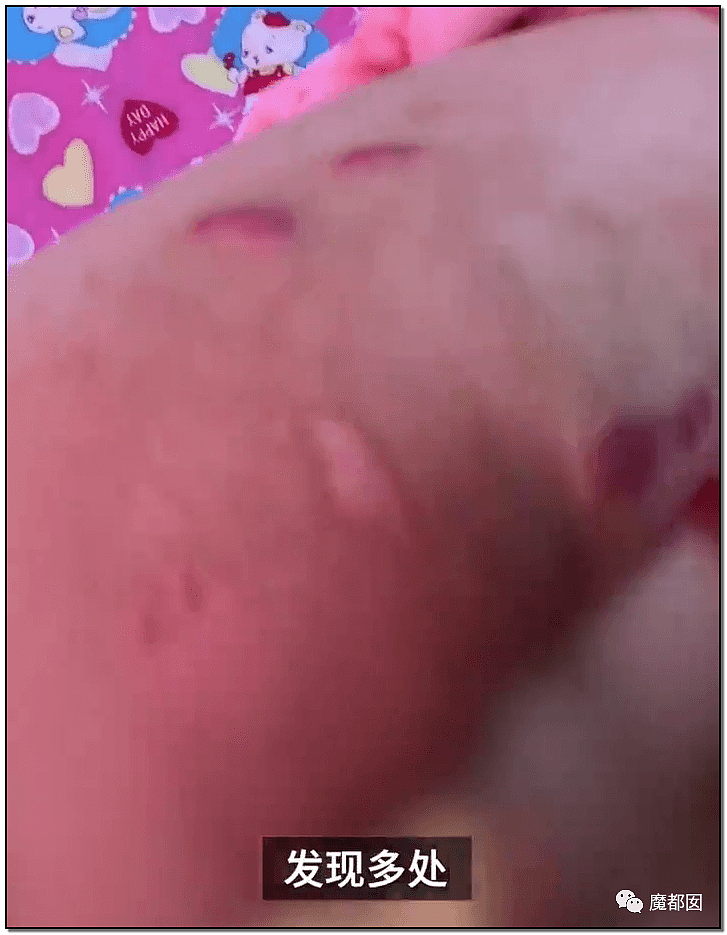 内幕扒出！沸水浇、钳拔牙、掰碎手、烧嘴唇…中国6岁女童被亲妈虐惨（视频/组图） - 87