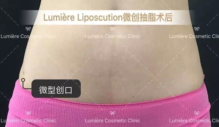 Lumière Cosmetic || 微创抽脂，轻松拥有超模腿，马甲线！ - 8