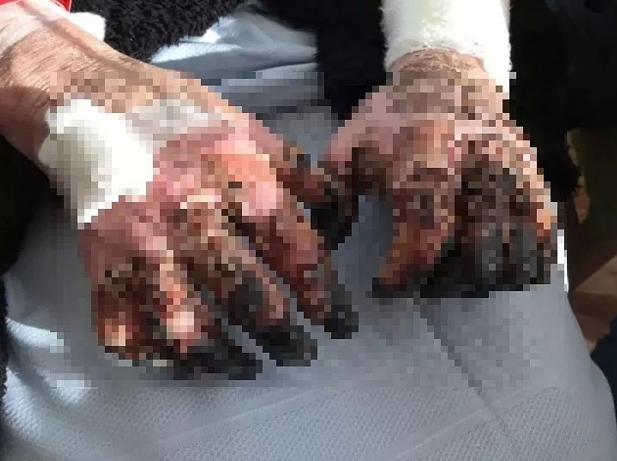 澳洲老太昏迷9天丧命，只因被猫舔了一口！因为被狗舔， 他们面部毁容、全身红斑， 四肢坏死…（组图） - 33