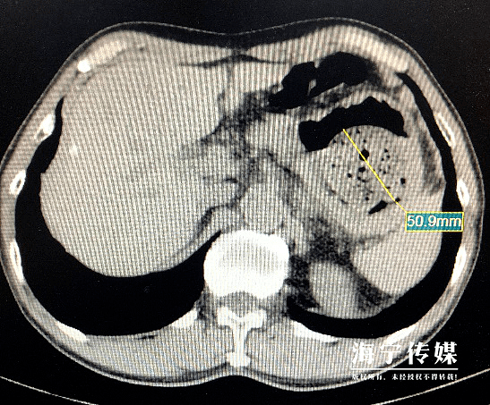 男子体内长出“金石”！医生一看：你是不是爱吃这个？（组图） - 3