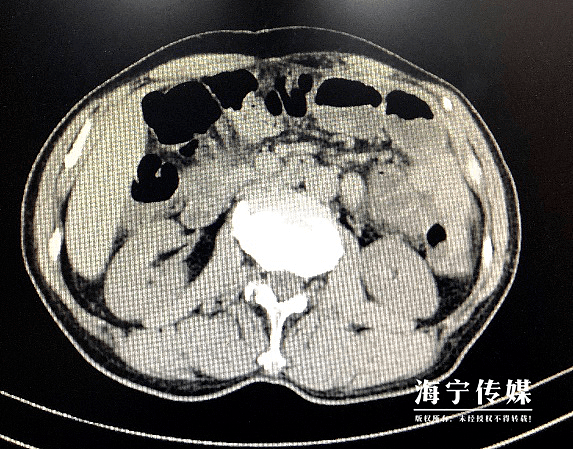 男子体内长出“金石”！医生一看：你是不是爱吃这个？（组图） - 8