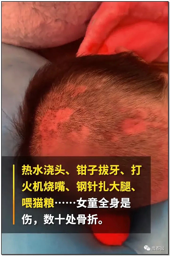 发抖！疯狂兽父烟头打火机狠烧，7岁幼儿烫伤腐烂面临截肢，画面不堪入目（组图） - 4