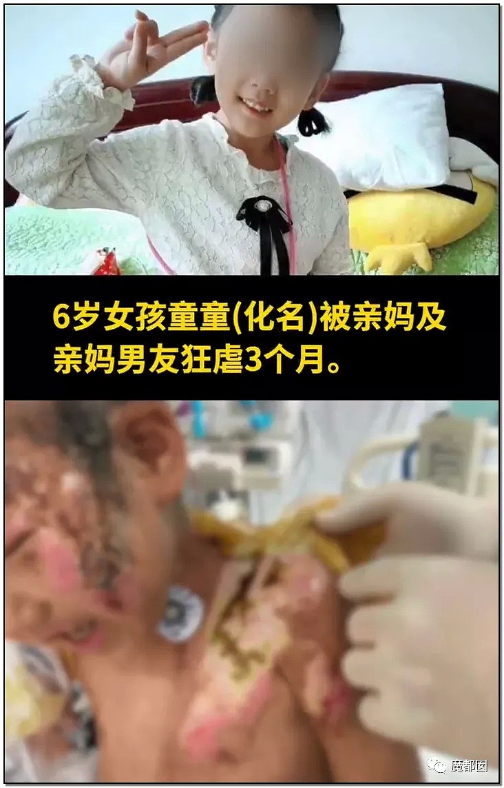 发抖！疯狂兽父烟头打火机狠烧，7岁幼儿烫伤腐烂面临截肢，画面不堪入目（组图） - 3