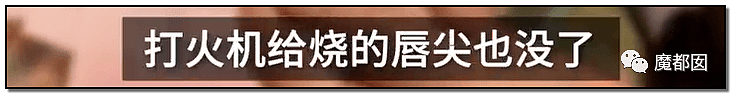 发抖！疯狂兽父烟头打火机狠烧，7岁幼儿烫伤腐烂面临截肢，画面不堪入目（组图） - 8