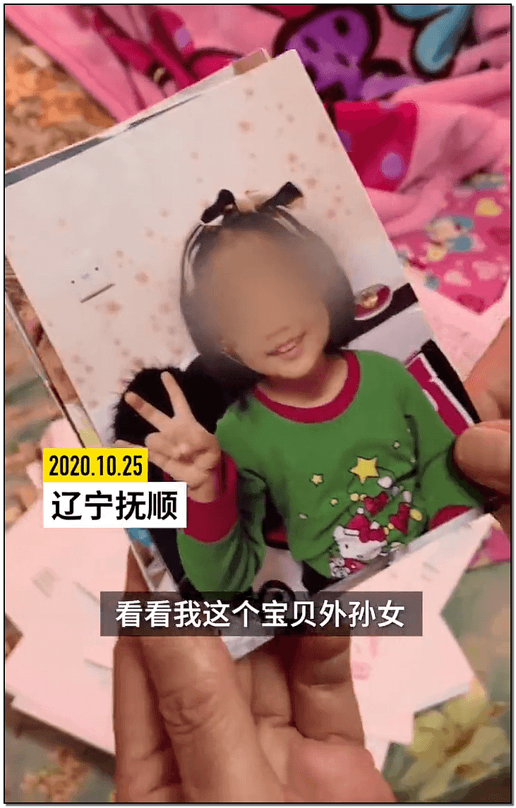 发抖！疯狂兽父烟头打火机狠烧，7岁幼儿烫伤腐烂面临截肢，画面不堪入目（组图） - 1