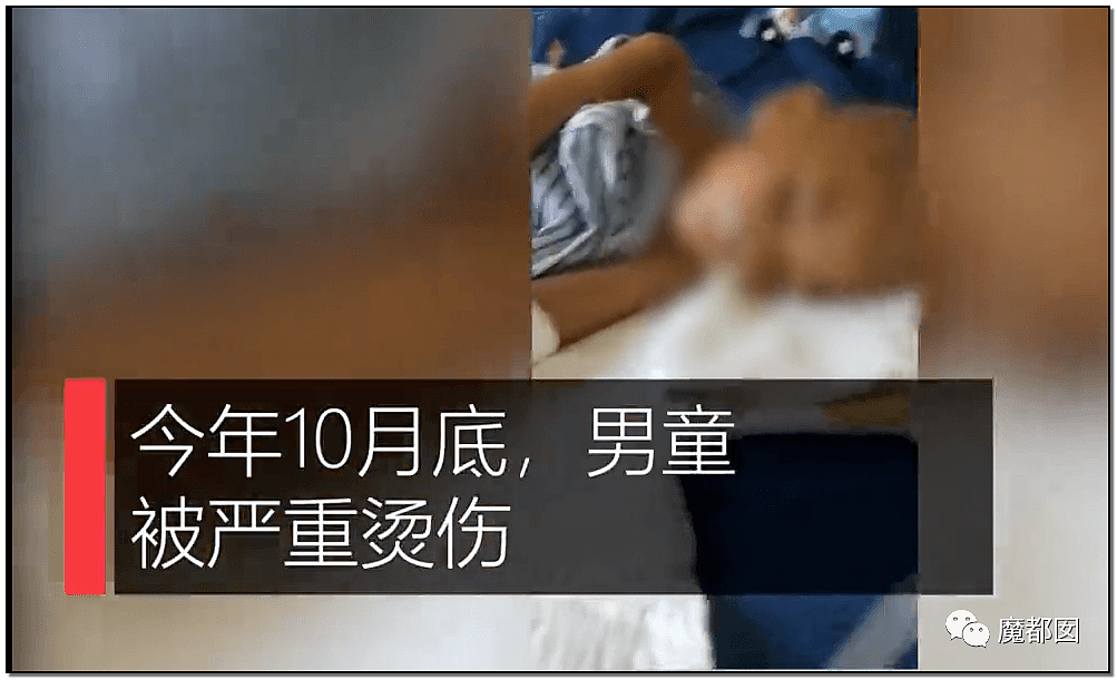 发抖！疯狂兽父烟头打火机狠烧，7岁幼儿烫伤腐烂面临截肢，画面不堪入目（组图） - 30