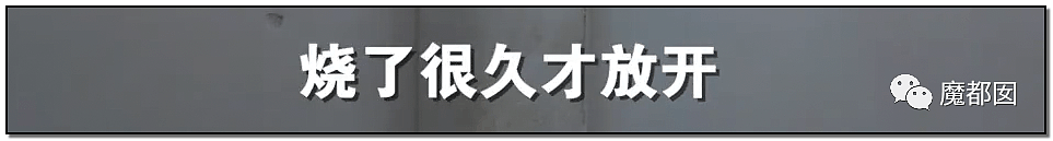 发抖！疯狂兽父烟头打火机狠烧，7岁幼儿烫伤腐烂面临截肢，画面不堪入目（组图） - 40