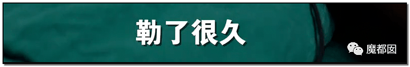 发抖！疯狂兽父烟头打火机狠烧，7岁幼儿烫伤腐烂面临截肢，画面不堪入目（组图） - 42