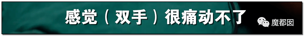 发抖！疯狂兽父烟头打火机狠烧，7岁幼儿烫伤腐烂面临截肢，画面不堪入目（组图） - 45