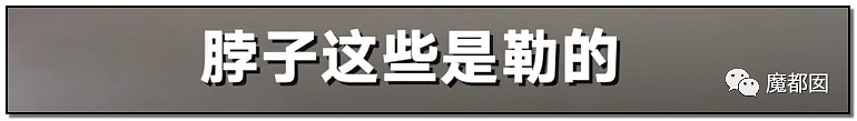 发抖！疯狂兽父烟头打火机狠烧，7岁幼儿烫伤腐烂面临截肢，画面不堪入目（组图） - 55