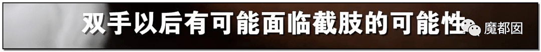 发抖！疯狂兽父烟头打火机狠烧，7岁幼儿烫伤腐烂面临截肢，画面不堪入目（组图） - 64