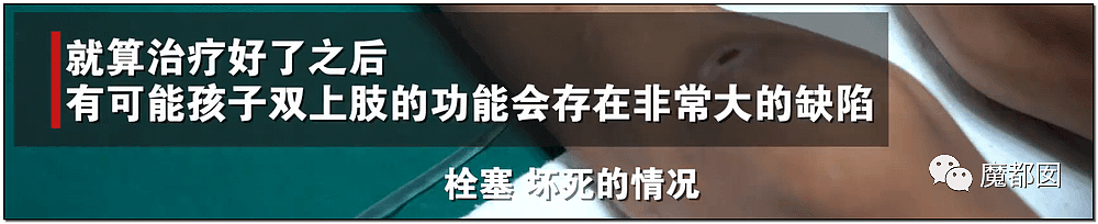 发抖！疯狂兽父烟头打火机狠烧，7岁幼儿烫伤腐烂面临截肢，画面不堪入目（组图） - 65