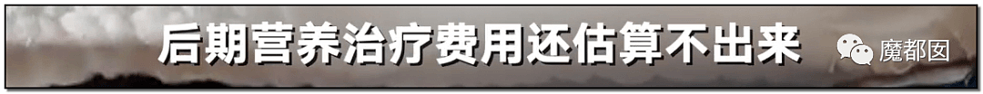 发抖！疯狂兽父烟头打火机狠烧，7岁幼儿烫伤腐烂面临截肢，画面不堪入目（组图） - 72