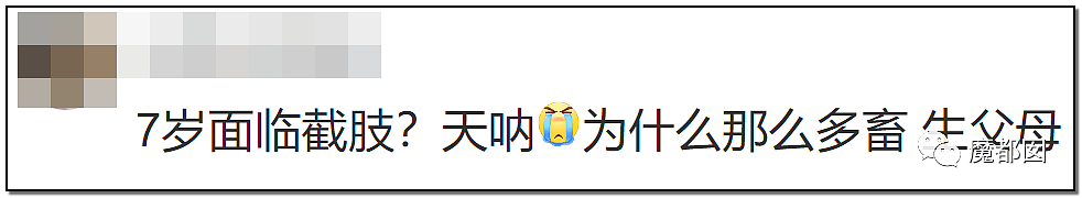 发抖！疯狂兽父烟头打火机狠烧，7岁幼儿烫伤腐烂面临截肢，画面不堪入目（组图） - 80