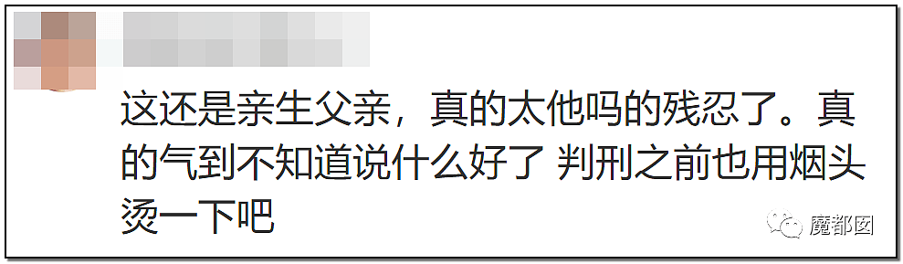 发抖！疯狂兽父烟头打火机狠烧，7岁幼儿烫伤腐烂面临截肢，画面不堪入目（组图） - 81