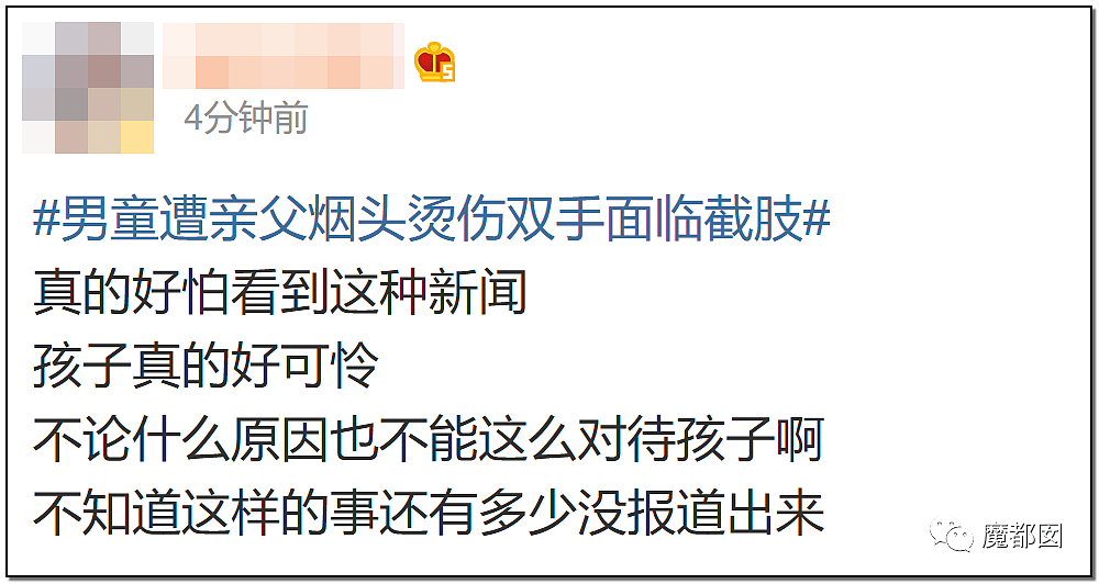 发抖！疯狂兽父烟头打火机狠烧，7岁幼儿烫伤腐烂面临截肢，画面不堪入目（组图） - 91