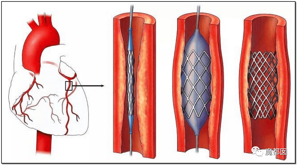 心脏支架竟可从1万3降到700！到底是谁在吸中国老百姓的血汗钱？（组图） - 2