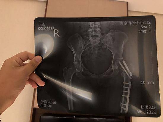 2019年8月，南京医院X光片。
