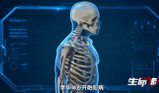 骨头被打入22根钢钉，身体被“敲断”4次：弯了28年后的中国男子，终于变直了！（组图） - 4