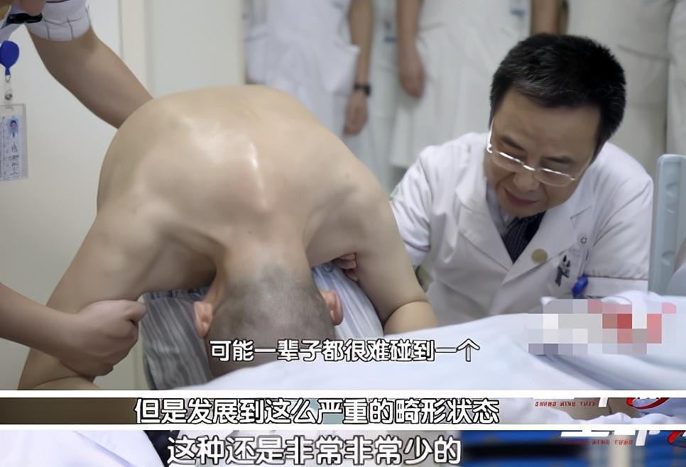 骨头被打入22根钢钉，身体被“敲断”4次：弯了28年后的中国男子，终于变直了！（组图） - 15