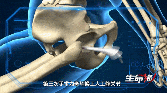 骨头被打入22根钢钉，身体被“敲断”4次：弯了28年后的中国男子，终于变直了！（组图） - 19